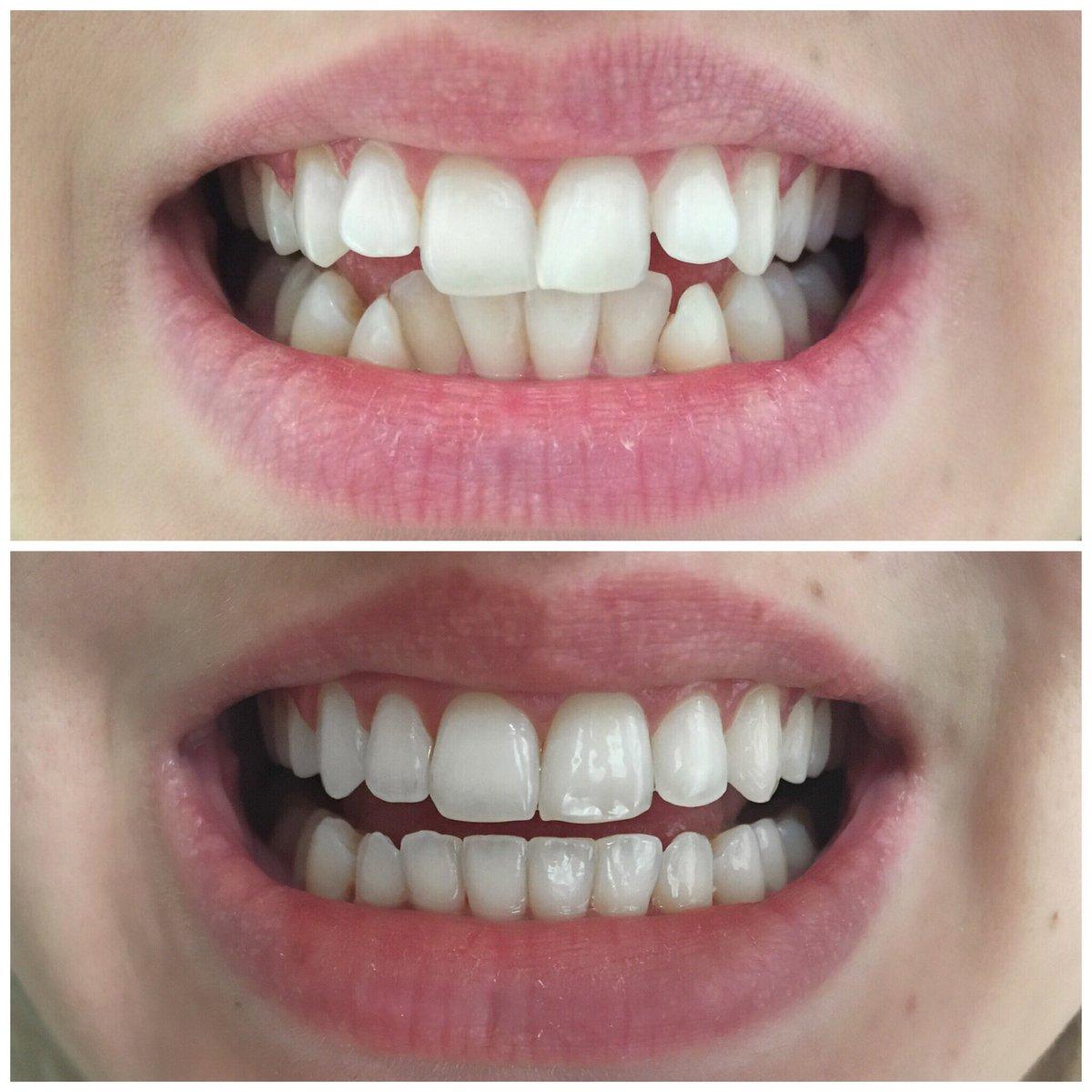 Illustrative before and after example of gap closure and smile design with veneers