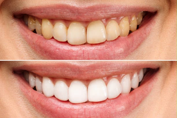 Illustrative before and after example of teeth whitening and contouring