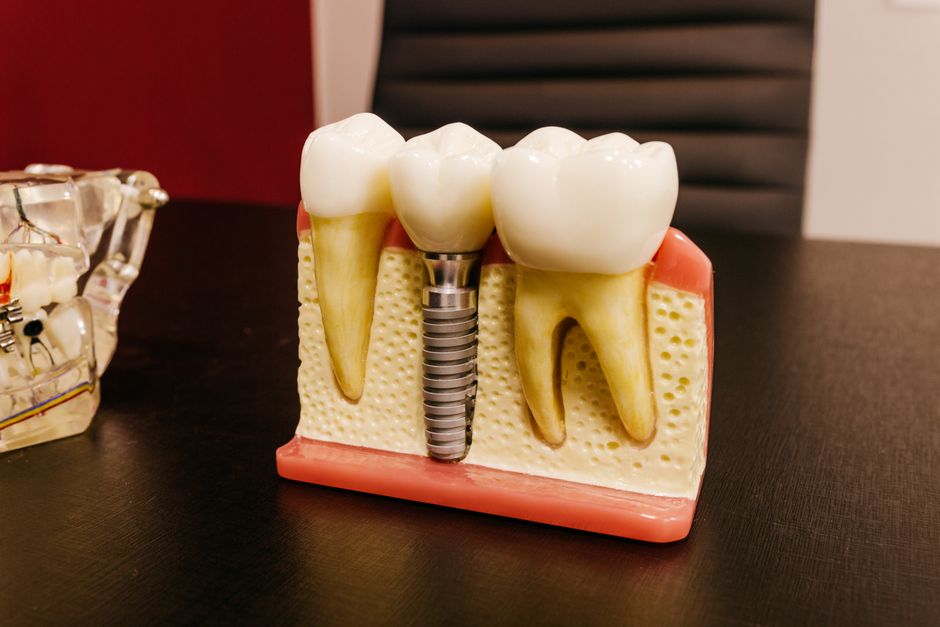 Implant-supported denture model