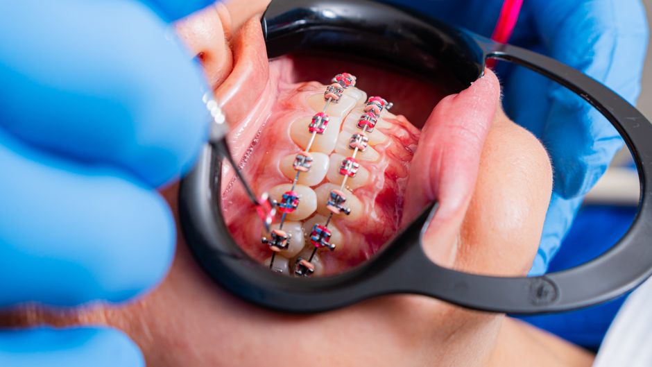 Orthodontic dental braces