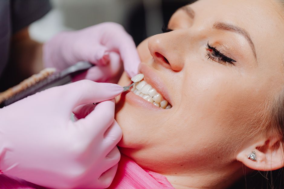 Dental veneers shade matching