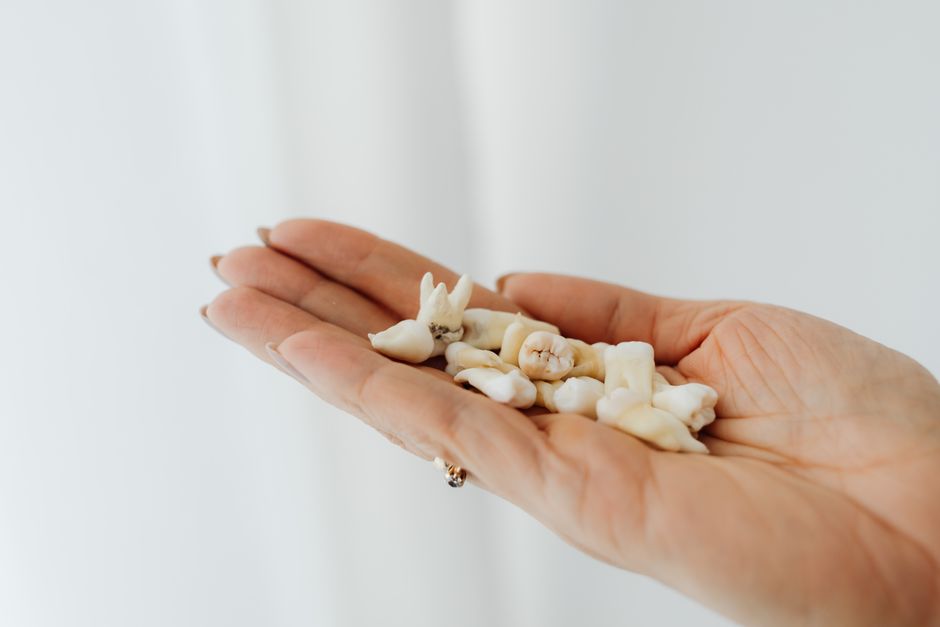 Wisdom tooth dental treatment